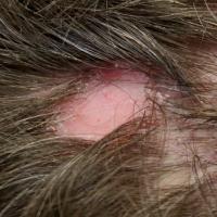 
	Scarring alopecia

	Shiny, atrophic and loss of…
