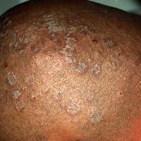 
	Tinea capitis