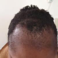 Traction alopecia
Copied with kind permission…