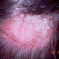 
	Discoid lupus erythematosus&nbsp;
Copied with…