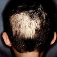 
	Trichotillosis

	An unusually shaped patch of…
