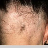 
	Alopecia areata - ophiasis pattern