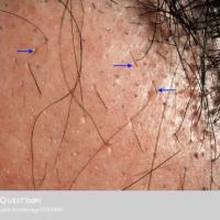 
	Exclamation mark hairs and black dots&nbsp;