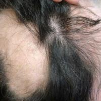 
	Alopecia areata with signs of regrowth
	
	Fine…