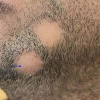 
	Alopecia areata affecting the beard

	Regrowth…