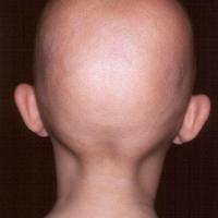 
	Alopecia totalis

	Copied with kind permission…
