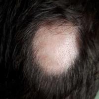 Alopecia areata
Copied with kind permission from…