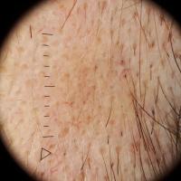 Dermoscopic image of&nbsp;previous figure -…