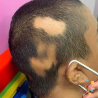 Alopecia areata&nbsp;
Copied with kind…