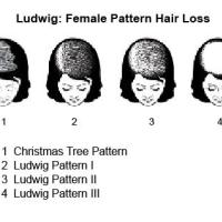 
	Female pattern alopecia