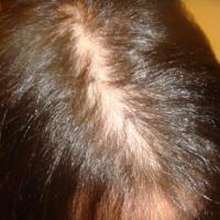 
	Female pattern alopecia