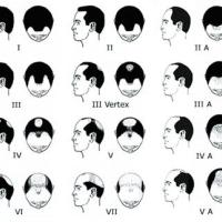 
	Male pattern alopecia