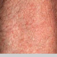 
	Papular amyloidosis with hair loss