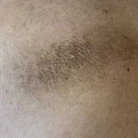 
	Macular amyloidosis

	A&nbsp;rippled pattern of…