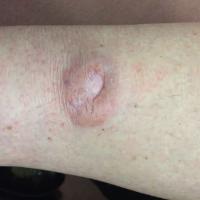 Nodular amyloid
Copied with kind permission from…