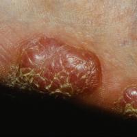 
	Nodular amyloidosis