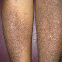 
	Papular amyloidosis