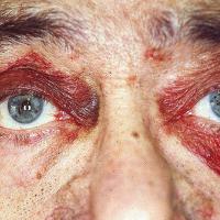 
	Systemic amyloidosis 

	Copied with kind…