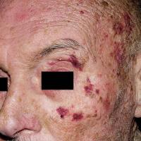 
	Systemic amyloidosis

	Copied with kind…