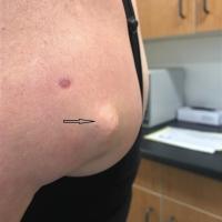 Anetoderma (arrow)&nbsp;
The other lesion is a…