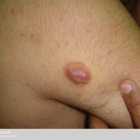
	Anetoderma - a herniated lesion