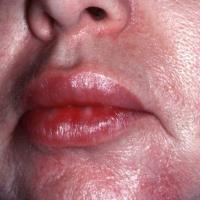 
	Angioedema
