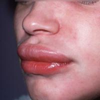 
	Angioedema