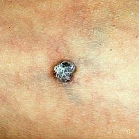 
	Solitary angiokeratoma

	Copied with kind…
