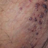 Angiokeratoma of Fordyce