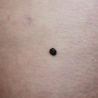 
	Solitary angiokeratoma