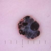 Dermoscopic appearance of the previous…