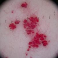 Dermoscopic appearance of previous figure