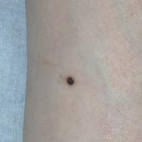
	A solitary angiokeratoma
	
	This lesion on a…