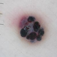 Dermoscopic appearance of the previous figure