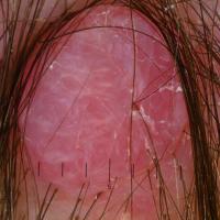 Dermoscopic appearance of previous figureCopied…