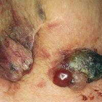 
	Angiosarcoma 

	Copied with kind permission…