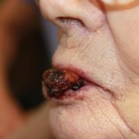 
	Angiosarcoma 