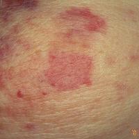 
	Angiosarcoma

	Copied with kind permission from…