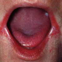 
	Angular cheilitis with proven candida infection