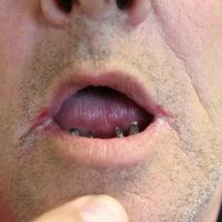 
	Angular cheilitis