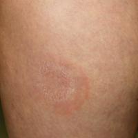 
	Erythema annulare centrifugum