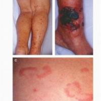 
	Sj&ouml;gren's syndrome - cutaneous…