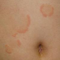 
	Erythema annulare centrifugum

	Copied with…