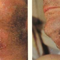
	Cutaneous anthrax on the neck 

	Early ulcer…