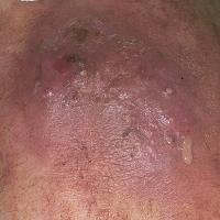 
	Cutaneous anthrax - early

	Copied with kind…