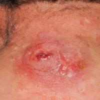 
	Cutaneous anthrax - ulceration

	Copied with…