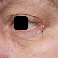 
	Apocrine hidrocystoma
	
	
	
	&nbsp;
