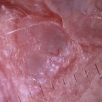 
	Dermoscopic appearance of the previous image