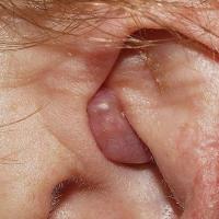
	Cylindroma on left ear

	Copied with kind…