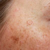 
	Trichoepithelioma - desmoplastic

	Image copied…